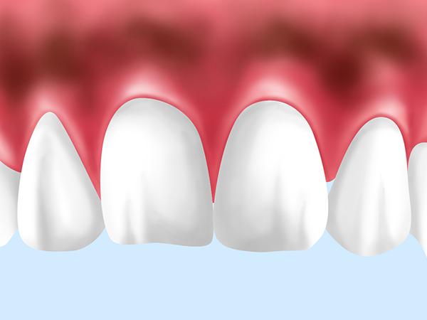 PICK UP　歯ぐきの黒ずみが気になる方へ