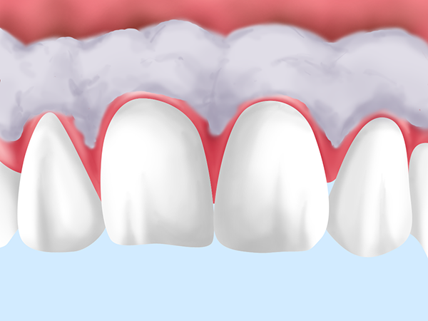 PICK UP　歯ぐきの黒ずみが気になる方へ