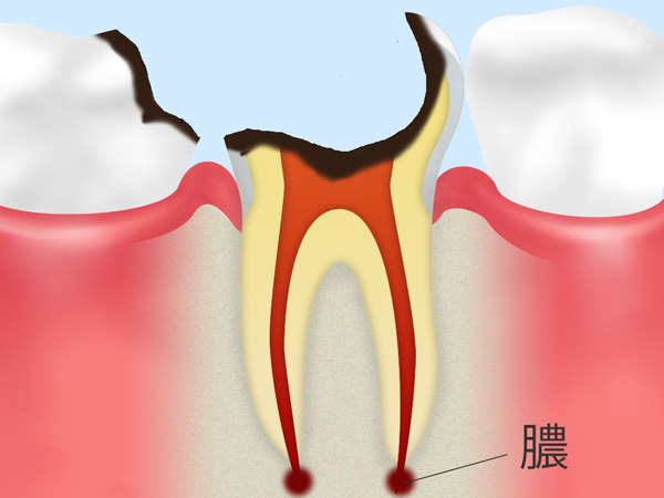 C4：歯根に達した虫歯