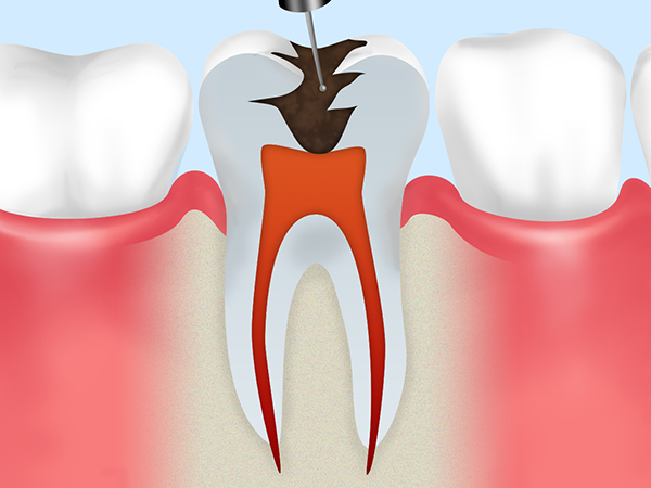 根管治療の流れ