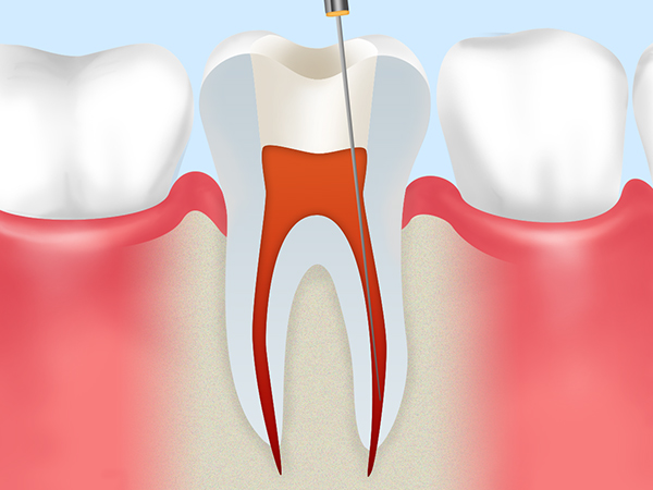 歯が痛い しみる 虫歯 根管治療 歯ぐきから血が出る 歯周病