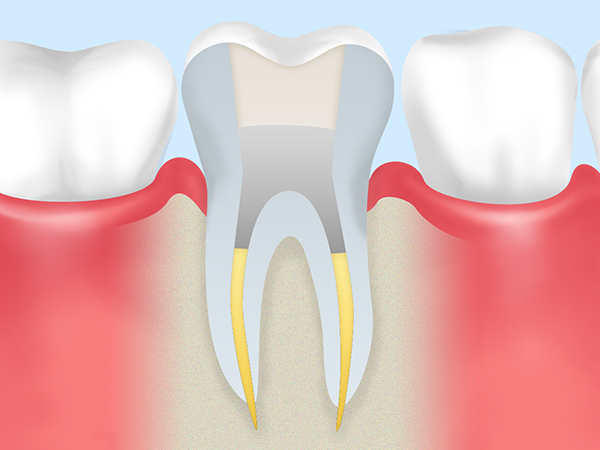 根管治療の流れ