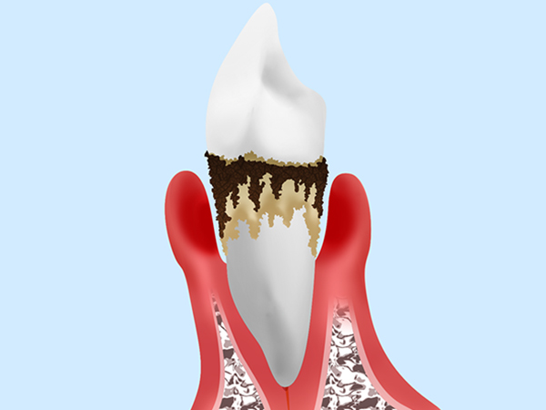 歯周病とその原因