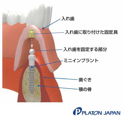 インプラントオーバーデンチャー