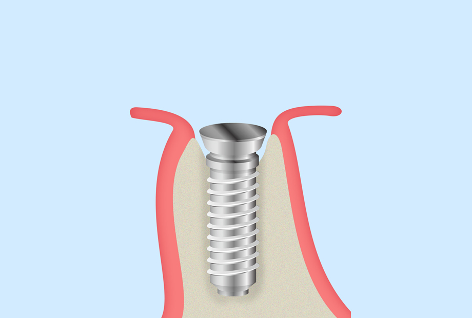 STEP 3一次手術