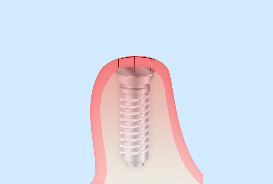 STEP 4治癒期間