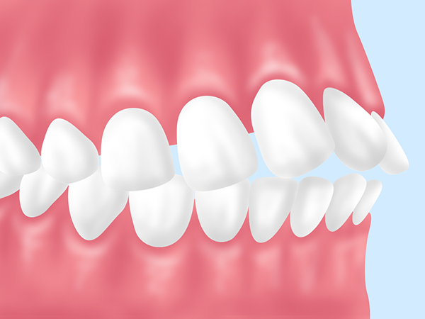 上下顎前突（じょうががくぜんとつ）