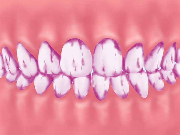 歯垢（プラーク）の染め出し